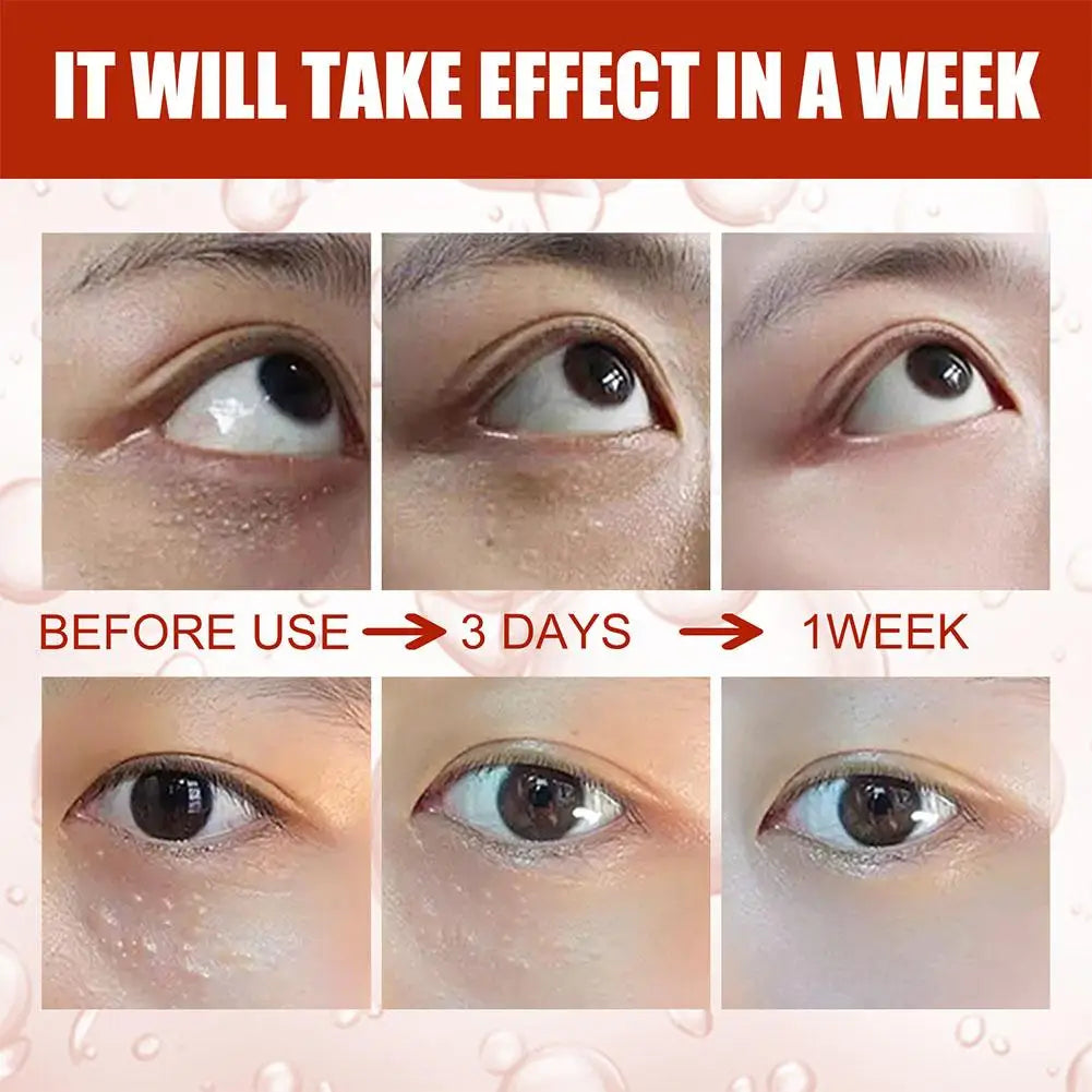 30ml Eye Fat Granules Removal Serum Effective Anti-Particles Eye Cicle Line Fine Fade Improve Serum Care Puffiness Dark F4A5
