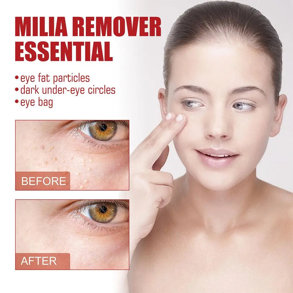 30ml Eye Fat Granules Removal Serum Effective Anti-Particles Eye Cicle Line Fine Fade Improve Serum Care Puffiness Dark F4A5