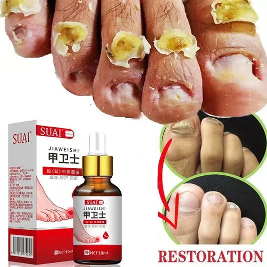 Beauty Health Relaxation Treatment Nail Fungal Treatment Serum Onychomycosis Paronychia Anti Infection Toe Fungus Hand Foot