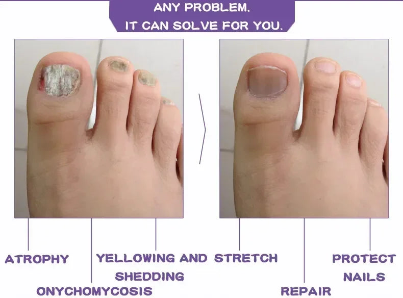 Beauty Health Relaxation Treatment Nail Fungal Treatment Serum Onychomycosis Paronychia Anti Infection Toe Fungus Hand Foot