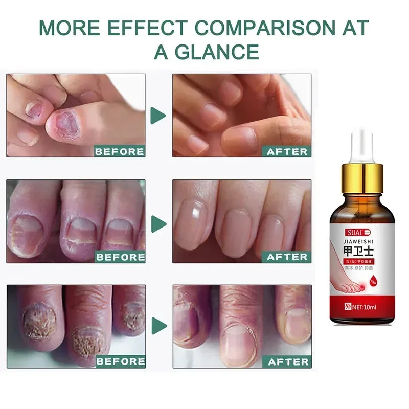 Beauty Health Relaxation Treatment Nail Fungal Treatment Serum Onychomycosis Paronychia Anti Infection Toe Fungus Hand Foot
