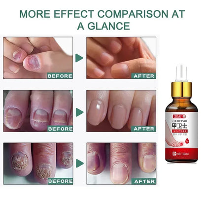 Beauty Health Relaxation Treatment Nail Fungal Treatment Serum Onychomycosis Paronychia Anti Infection Toe Fungus Hand Foot