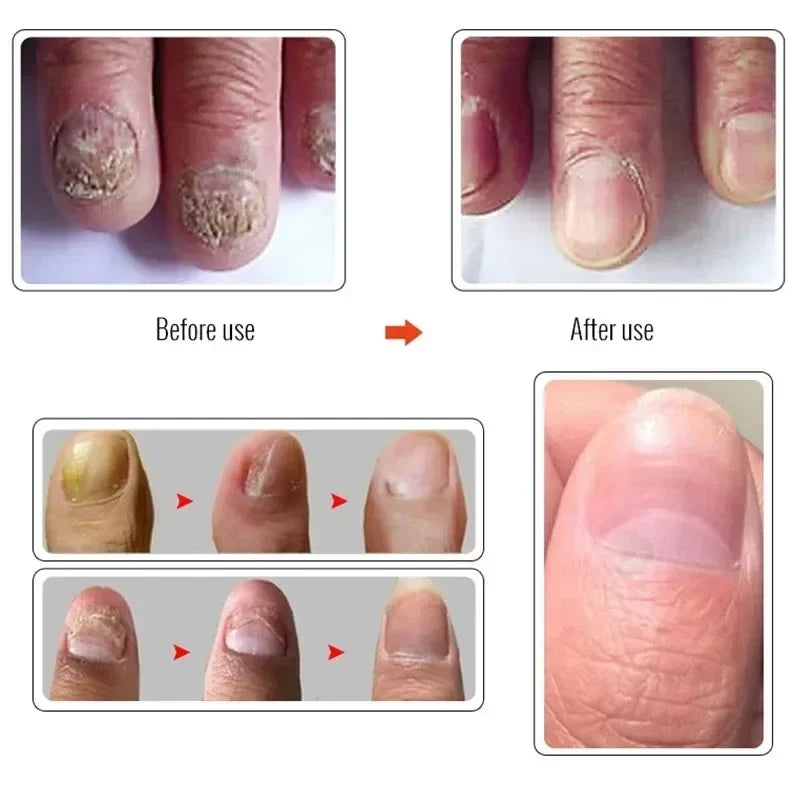 Beauty Health Relaxation Treatment Nail Fungal Treatment Serum Onychomycosis Paronychia Anti Infection Toe Fungus Hand Foot