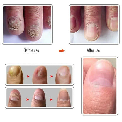 Beauty Health Relaxation Treatment Nail Fungal Treatment Serum Onychomycosis Paronychia Anti Infection Toe Fungus Hand Foot