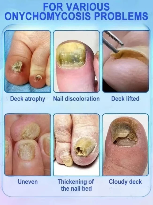Quickly eliminate fungus and restore healthy nails  9