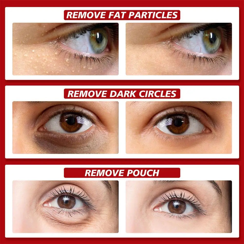 30ml Eye Fat Granules Removal Serum Effective Anti-Particles Eye Cicle Line Fine Fade Improve Serum Care Puffiness Dark F4A5